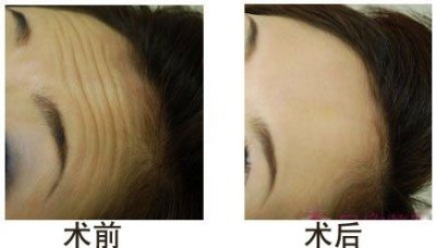 ​激光紧肤除皱效果可以维持多久呢（激光除皱术还你年轻的肌肤）