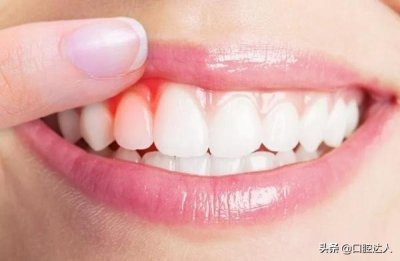 惊呆!没想到你居然是这样的牙结石…